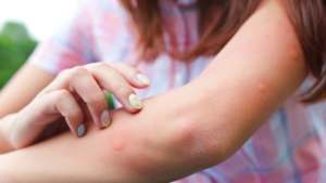 虫刺され注意報 中村皮ふ科クリニック